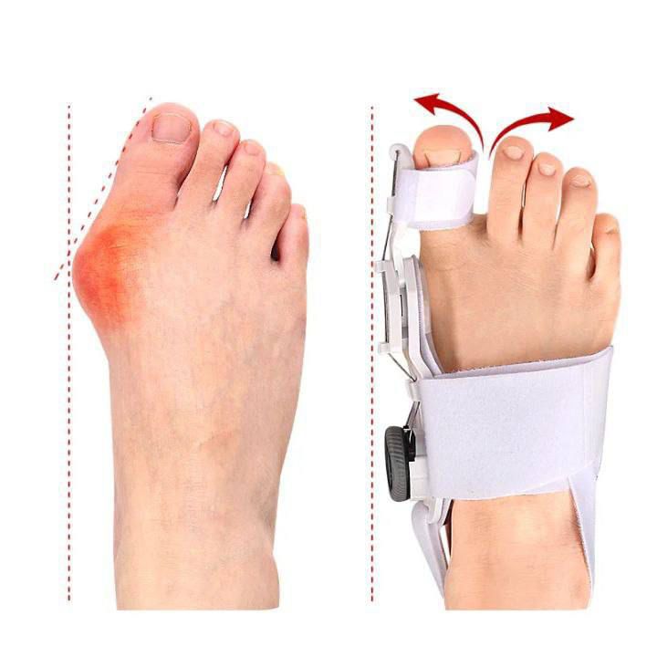 ✅ Corrector de juanetes ajustable